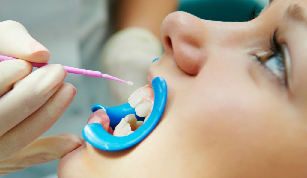 Как проходит процедура минерализации зубов