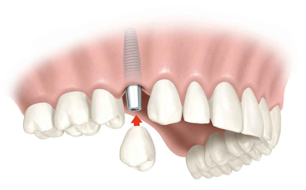 Как проходит одноэтапная имплантация зубов