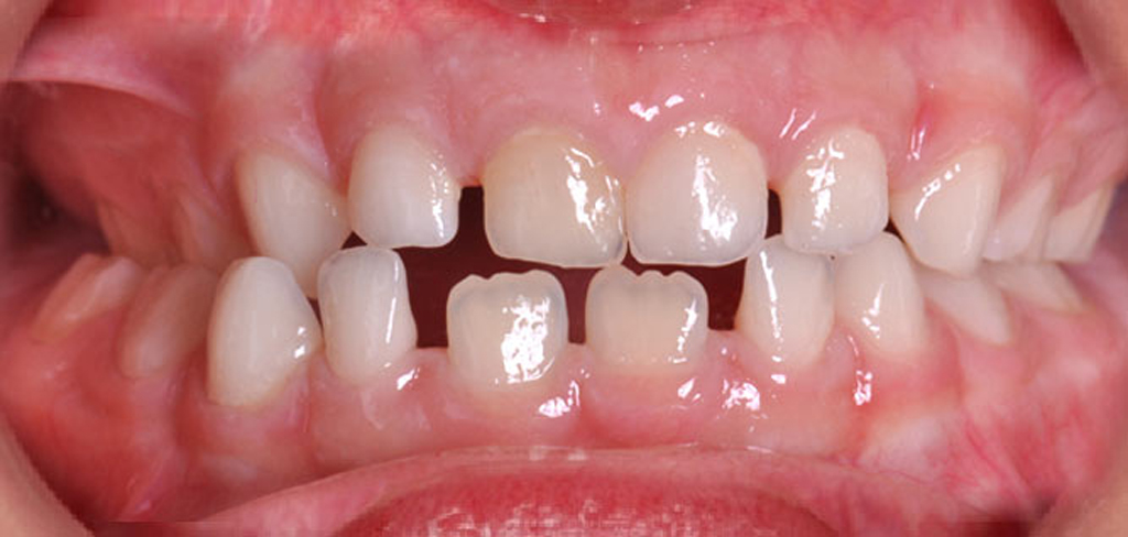 Обработанные зубы менее подвержены поражению кариесом