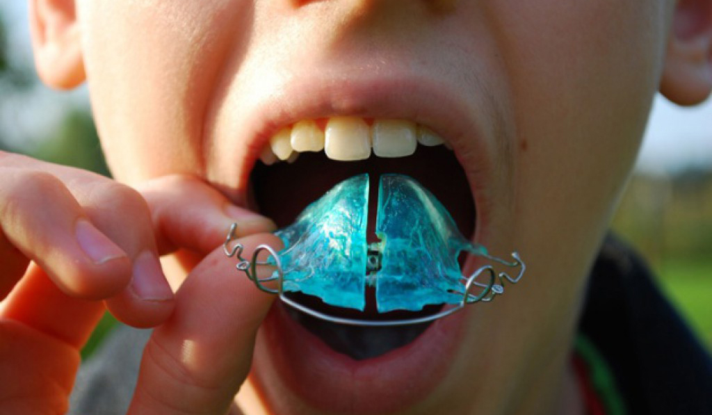 Детские зубы быстро адаптируются к пластинке