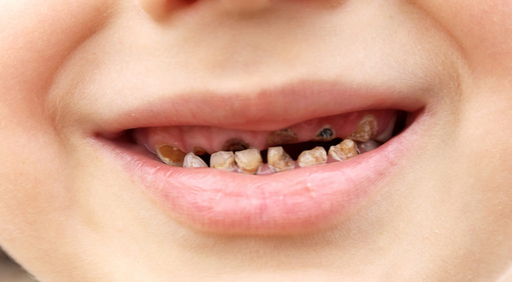 На фото показано гнилостное поражение зубов у ребенка