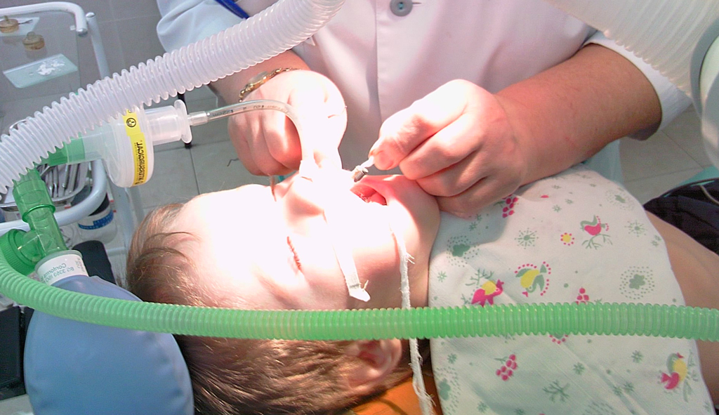 На фото показано лечение зубов ребенку под общим наркозом