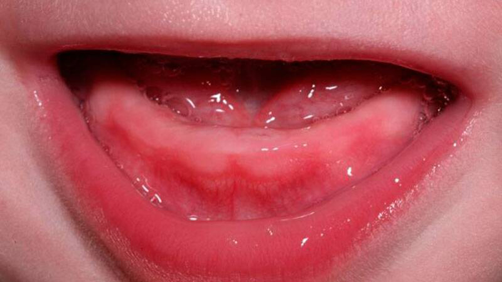 Отечность десен и повышенная слюневыделение - признаки прорезывания зубов 