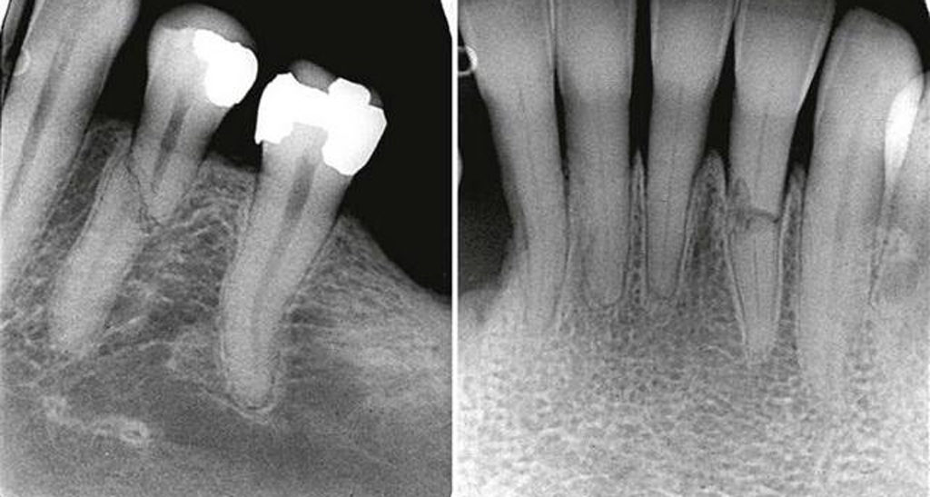 Перелом корня зуба возможно определить только по рентгеновскому снимку