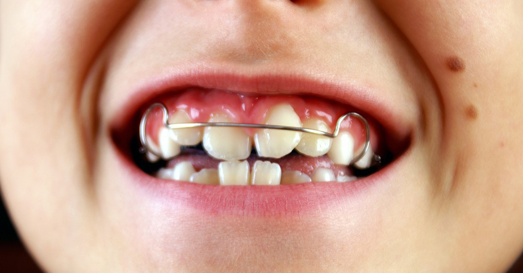 Детские зубы быстро адаптируются к пластинке