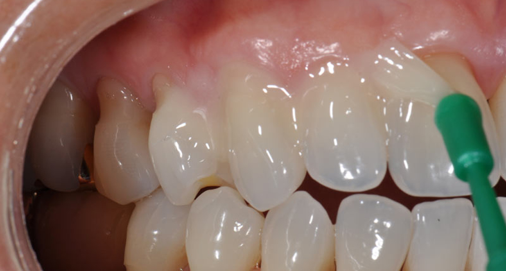 На фото показана реминерализация зубов