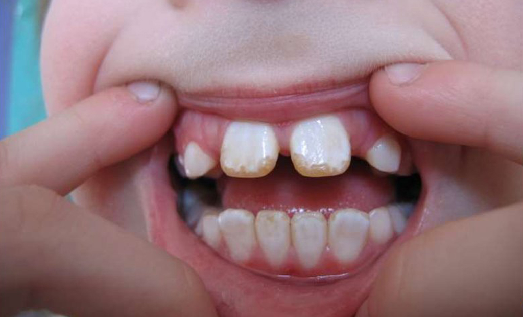 Флюороз на детских зубах