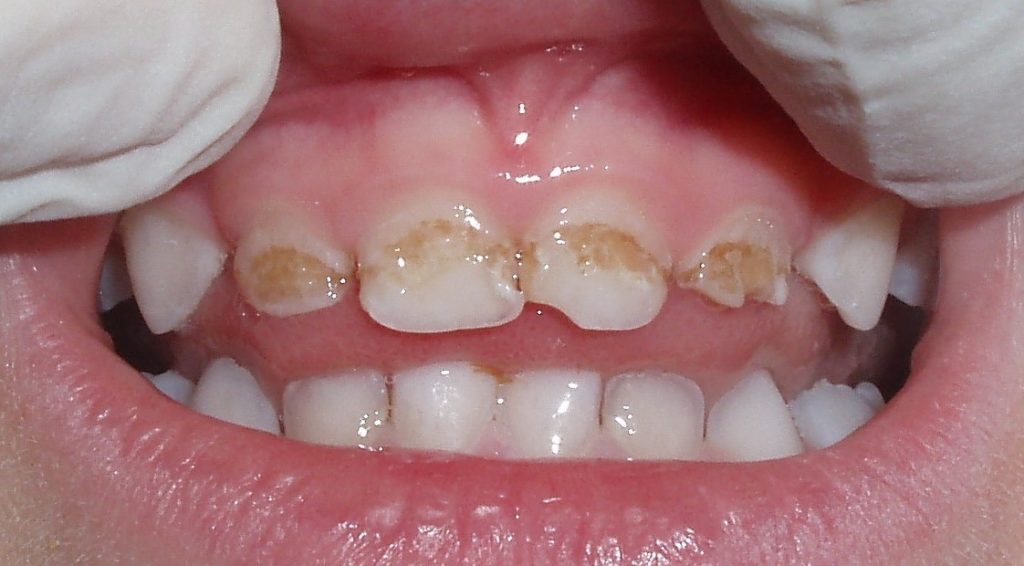 На фото показана эрозия зубной эмали 