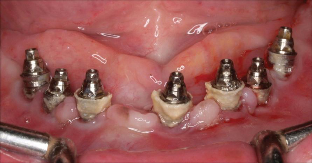 На фото показан периимплантит на нижней челюсти