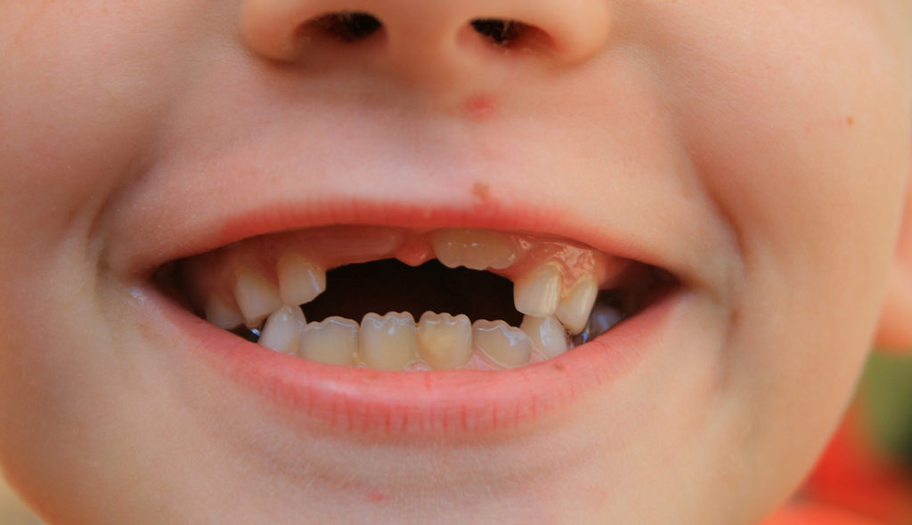 Есть ли у детей коренные зубы