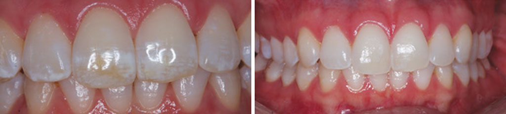 Фото зубов, пораженных флюорозом, до и после отбеливания