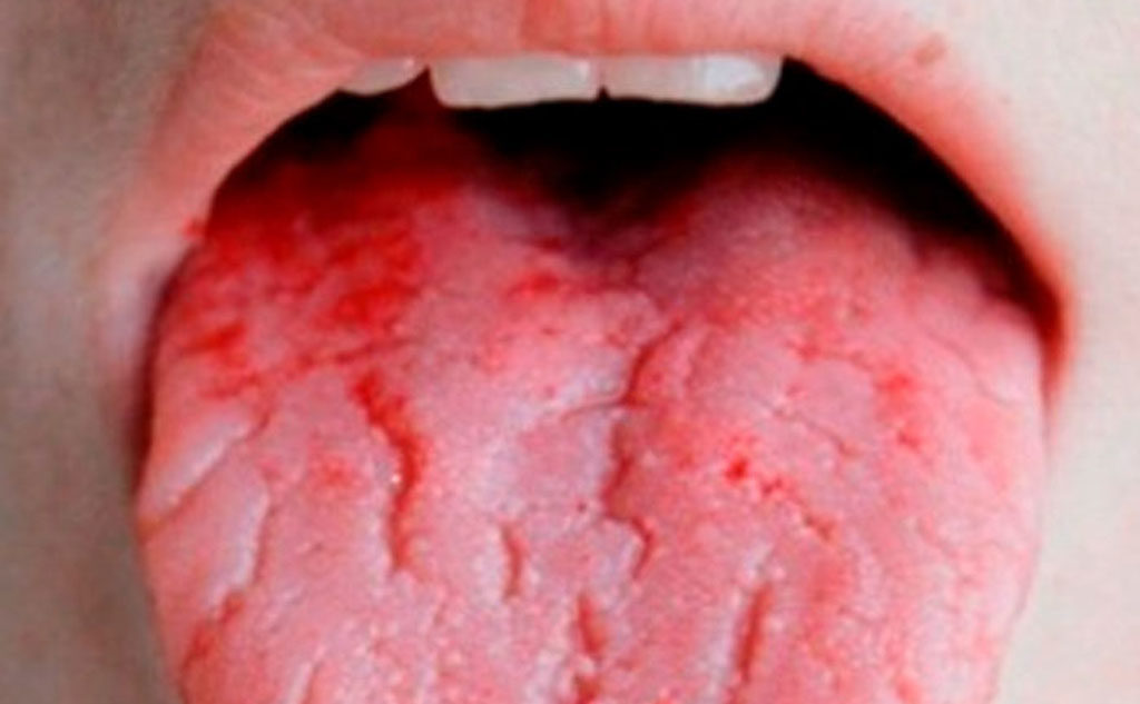 Почему же язык кровоточит?