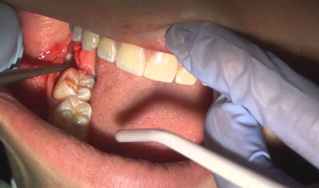 операция по извлечению ретинированного зуба
