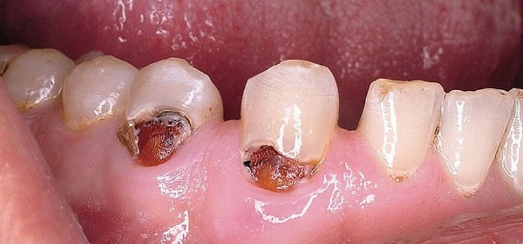 Пришеечный кариес может стать причиной отслоения десны от зуба