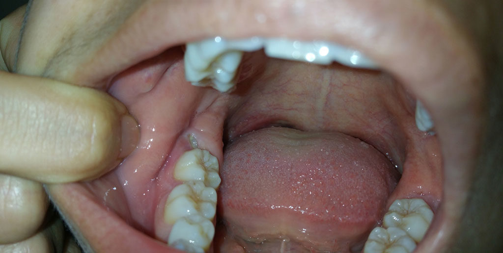 Затрудненное прорезывание зубов мудрости может спровоцировать опухоль щеки