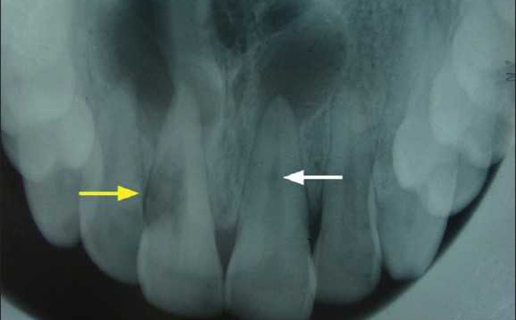 Рассосался корень зуба. Наружная цервикальная резорбция зуба. Наружная резорбция корня зуба.
