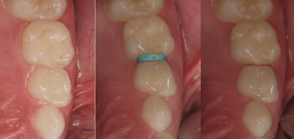 На фото показаны зубы до и после сепарации