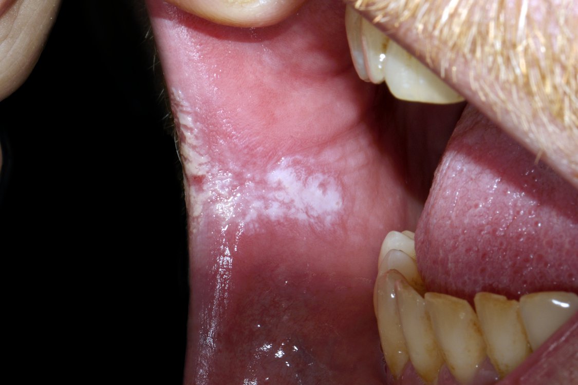 лейкоплакия полости рта