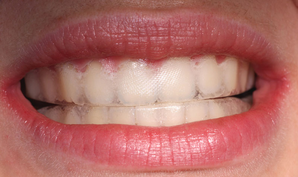Капа отбеливание зубов отзывы отбеливание зубов за 3 дня в