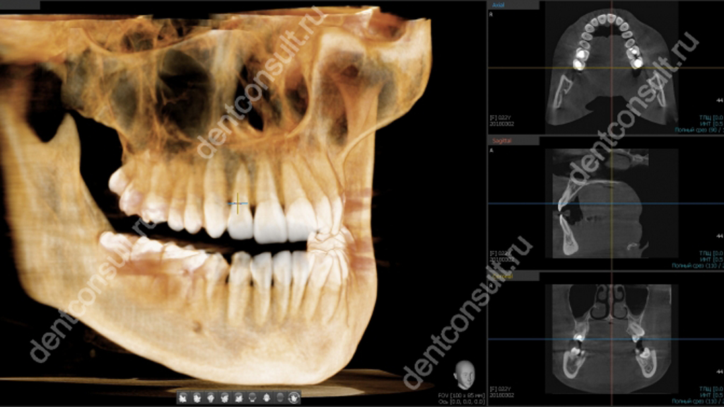 3д снимок челюсти. Кт верхней и нижней челюсти 3д это. Компьютерная томография нижней челюсти 15х15.