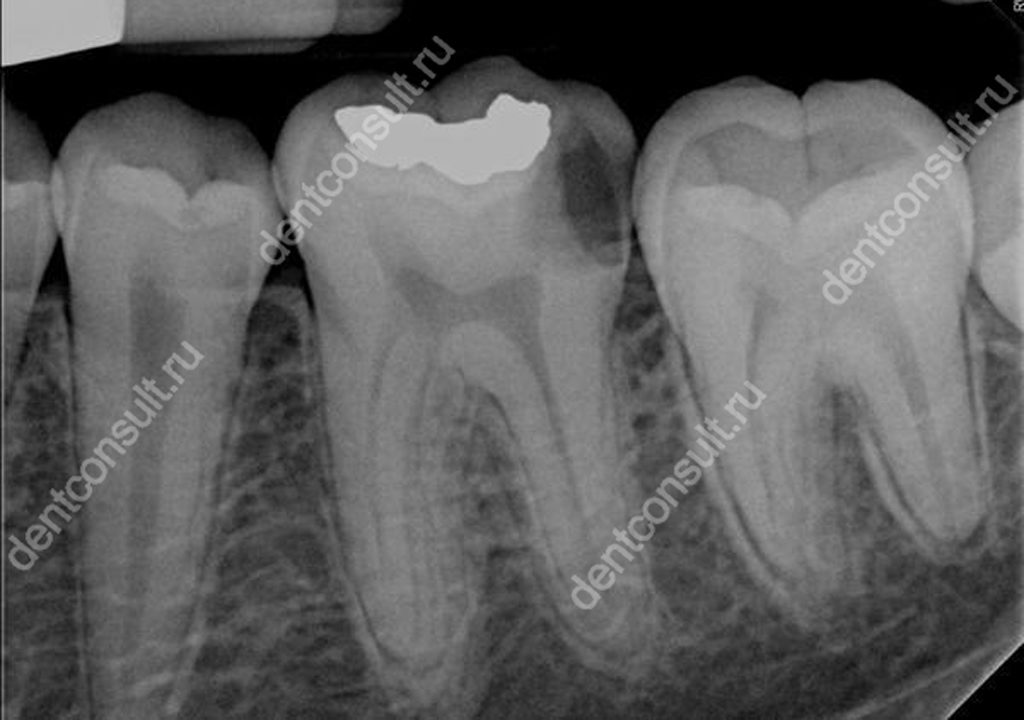 Рентген в стоматологии