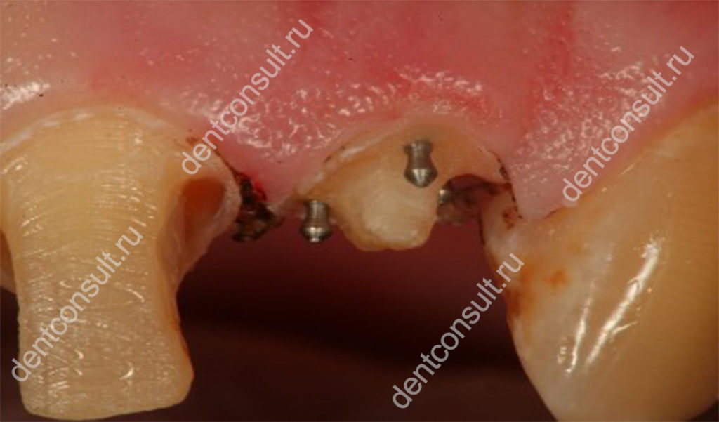 Количество стержней напрямую зависит от места расположения зуба 