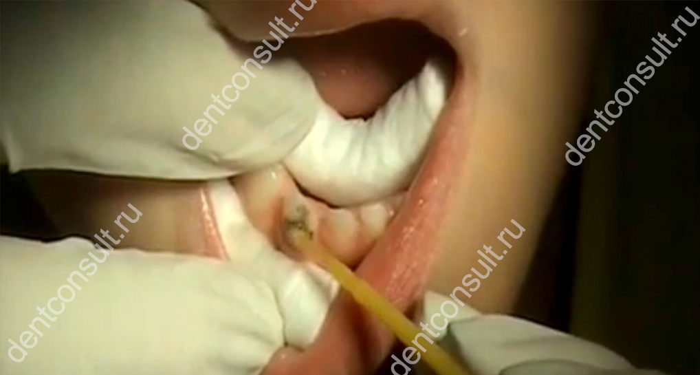 Серебрение молочных зубов процедура