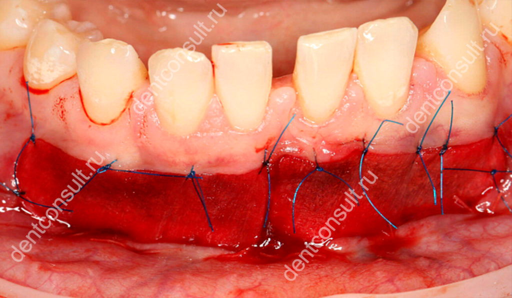 Вестибулопластика нижней челюсти