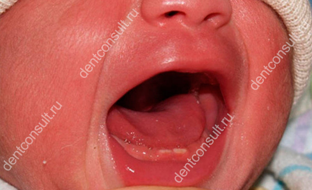 гипердонтия у новорожденных