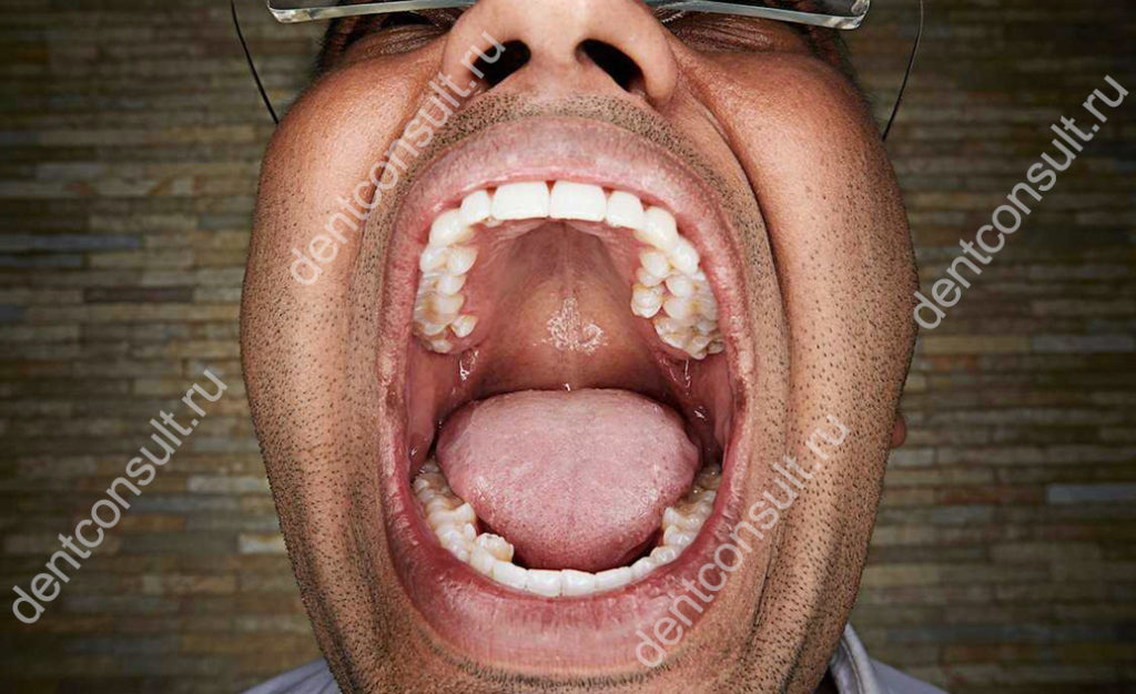 лишние зубы