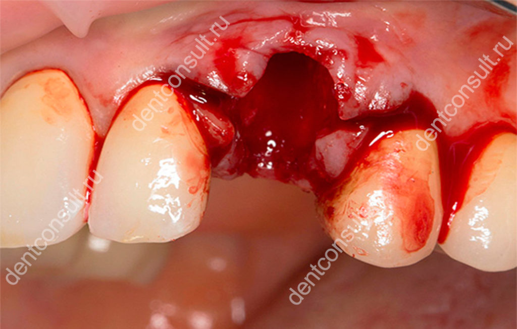 кровотечение после удаления зуба