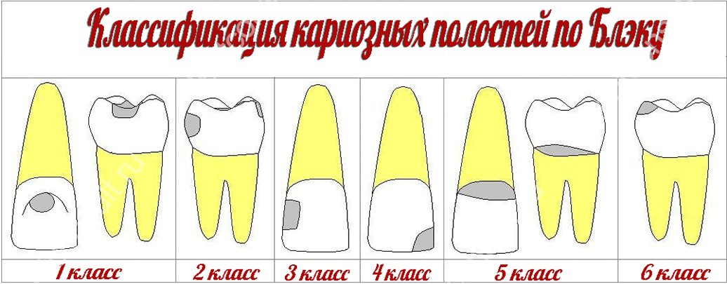 Классификация кариеса по блэку в картинках