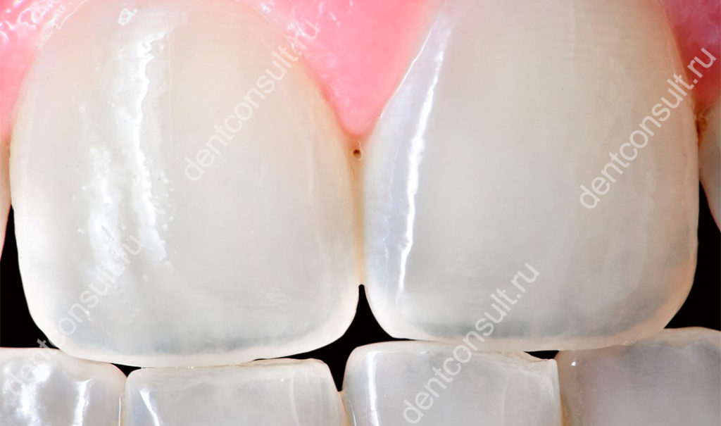 зубная эмаль