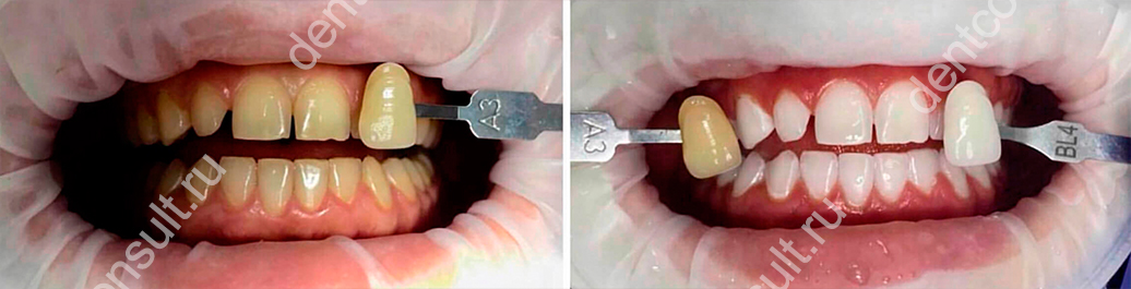Фото до и после фотоотбеливания зубов