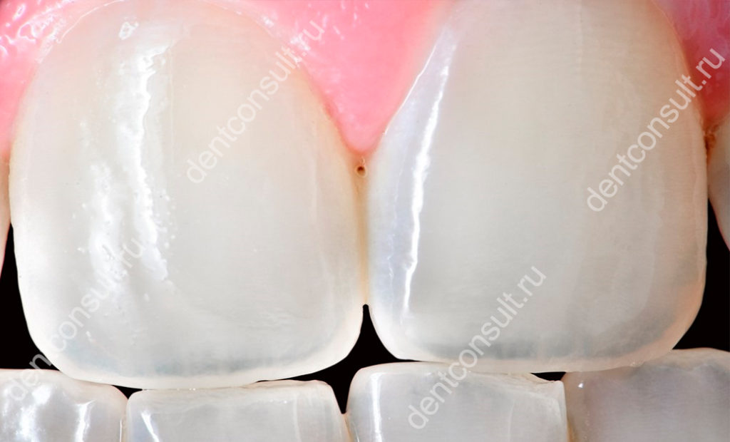 зубы становятся прозрачными