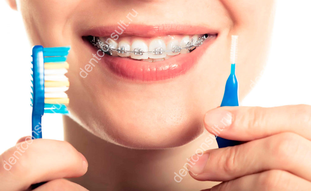 чистить зубы с брекетами