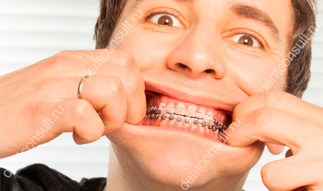 Брекеты на зубах фото у мужчин