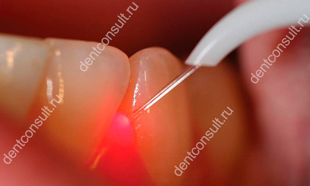 зубной налет чистка лазером