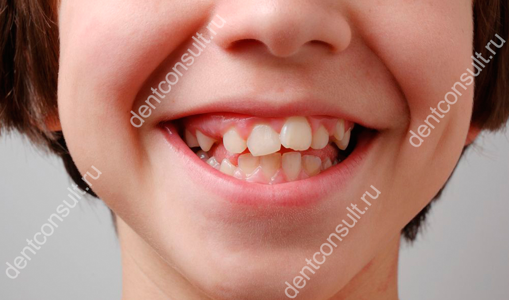 кривые зубы у ребенка