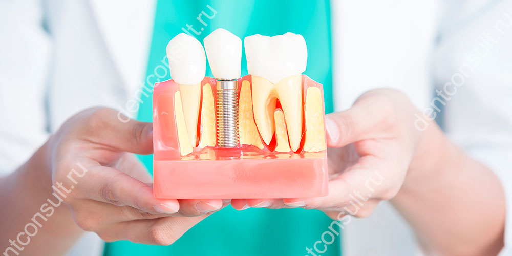 Через какое время после удаления зуба можно ставить имплант?