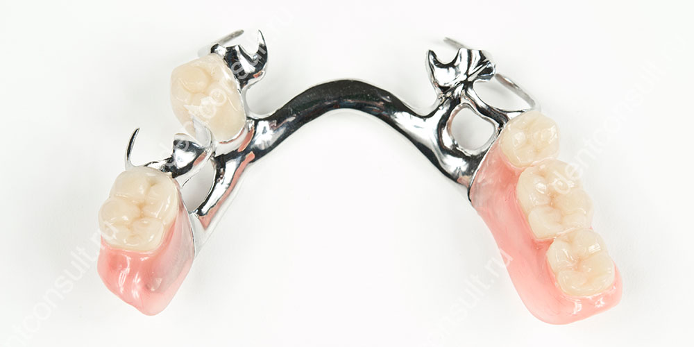 Кламмеры – это крючки, которые охватывают опорные зубы у самого основания для удержания всей конструкции в полости рта