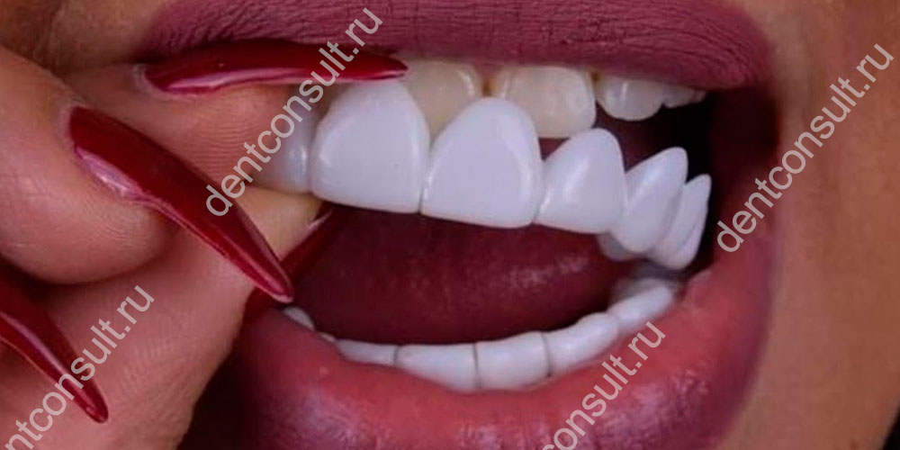 Съемные виниры на зубы – это своеобразные силиконовые или пластиковые каппы, которые обычно надевают сразу на весь ряд