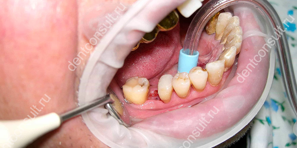 Гемисекция корня зуба