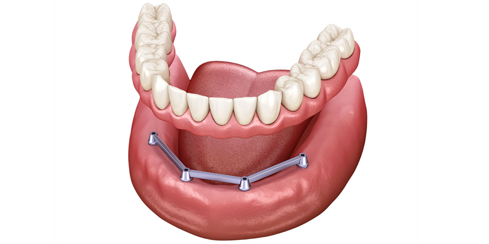 Условно-съемные зубные протезы на имплантах