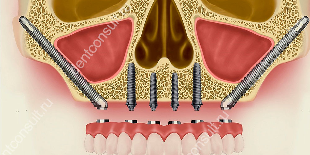 Восстановление части жевательных зубов на верхней челюсти с установкой удлиненных имплантов