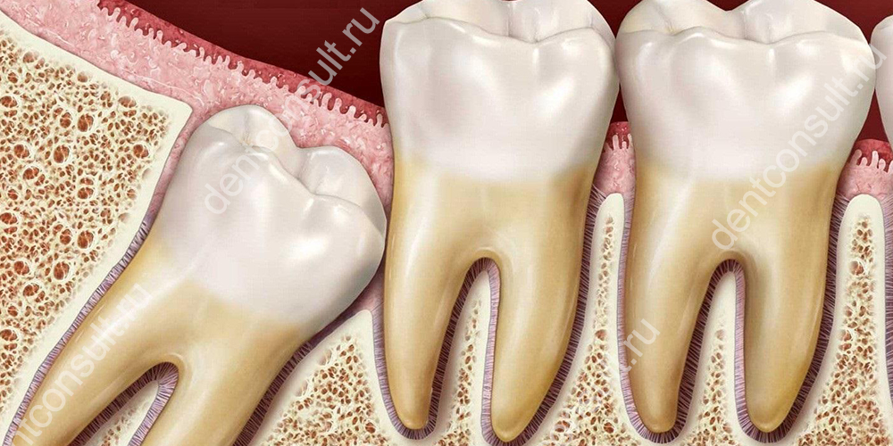 Дистопированный зуб мудрости – это патологическое явление, при котором последний в ряду моляр растет неправильно, его и положение его корней может быть сильно искривлено