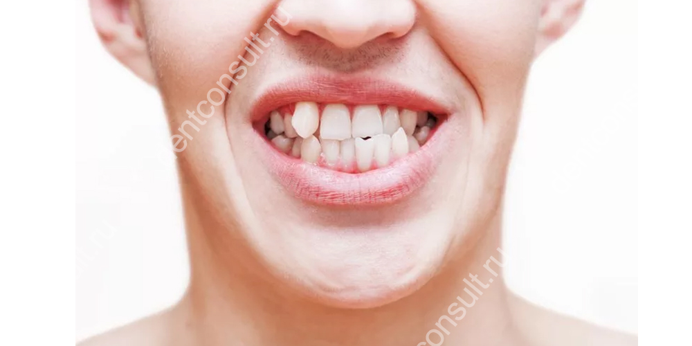 Смещение зубов причины и способы лечения