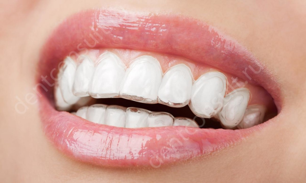 Элайнеры точно повторяют все анатомические изгибы зубного ряда