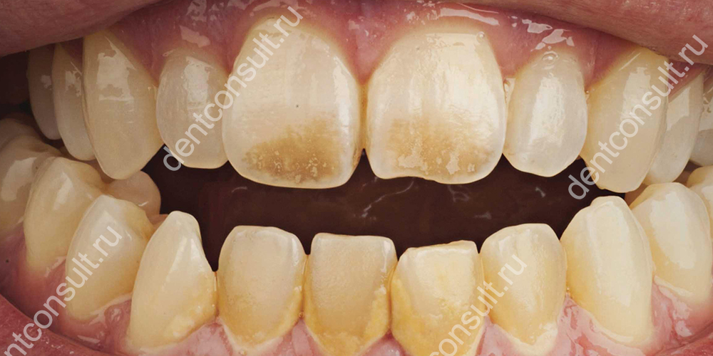 Красящие продукты для зубов особенно опасны, если твердые ткани ослаблены и деминерализованы.