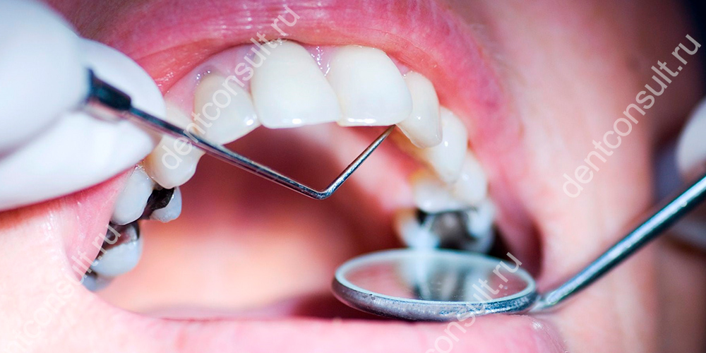 Липкая жвачка вполне может вытянуть из зуба старую и уже просевшую пломбу